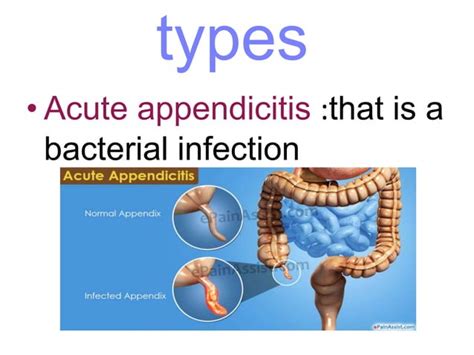 Image result for Appendicitis Position
