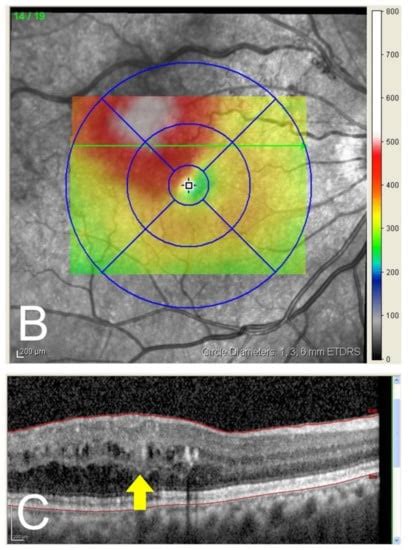 Direct Photocoagulation for Treating Microaneurysms with ...