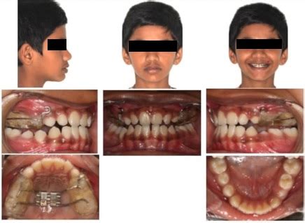 Effect of alternate rapid maxillary expansion and constriction on ...