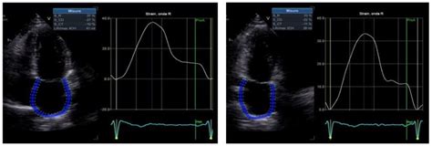 Hereditary Transthyretin Amyloidosis: How to Differentiate Carriers and ...