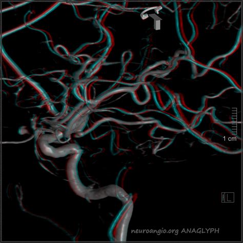 Anterior Choroidal Artery | neuroangio.org