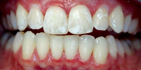 White Spots on Teeth after Braces treatment - Headgear Braces