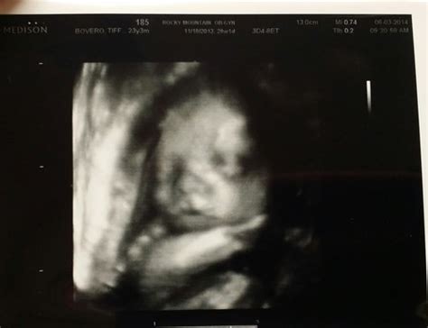 possible cleft lip? ultrasound picture | BabyCenter