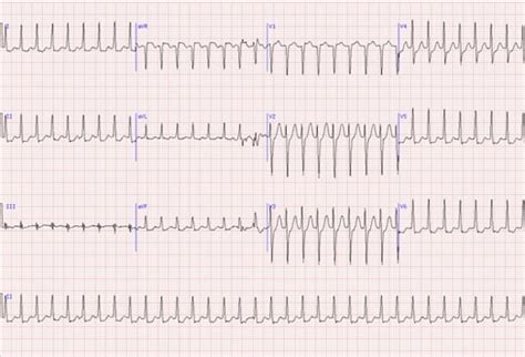 Image result for Synchronized Cardioversion SVT
