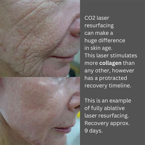 Transform Your Skin: CO2 Laser Resurfacing & Biostimulators