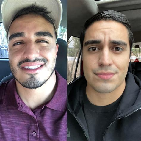 Left was 2017 I was 22 years old drinking every other day, right is December 2022 @ 27 years old ...
