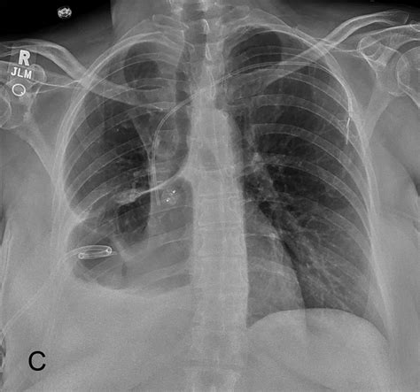 Hydropneumothorax in a non‐small cell lung cancer patient after ...