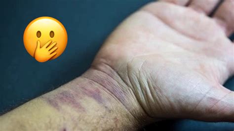 Is It Normal For Your Hand To Swell After Carpal Tunnel Surgery - Infoupdate.org