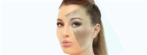 How to Treat Melasma on Indian Skin Effectively – World of Asaya