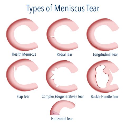 Arthroscopic Meniscectomy | Partial Meniscectomy