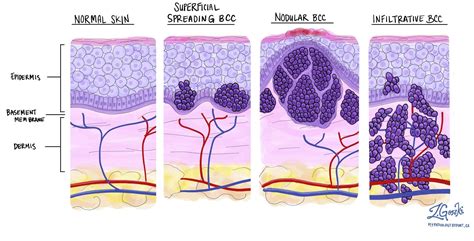 Basal cell carcinoma of the skin - MyPathologyReport.ca