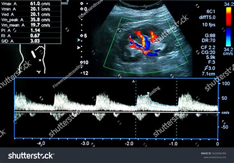 Renal Artery Ultrasound