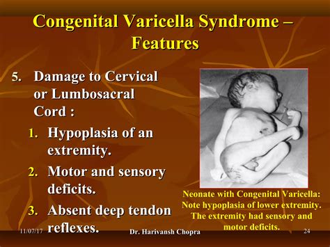Chickenpox (varicella) dr harivansh chopra | PPT