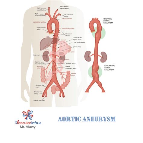 Thoracic Aortic Aneurysm - Vascular Info