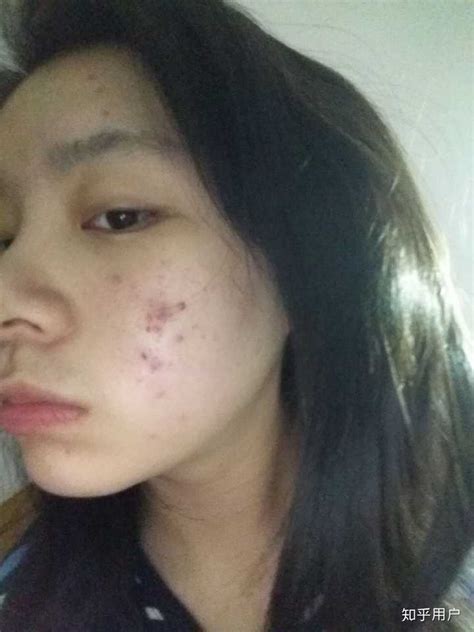 我的脸上长着红肿的痘痘，按着有点痛痛的，还有白点_百度知道