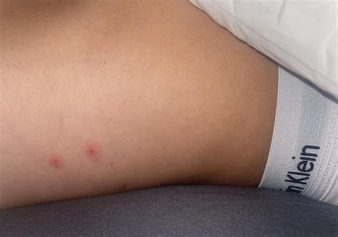 Image result for Bug Bite Identification Chart