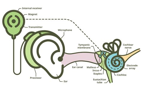 Image result for How Cochlear Implants Sound