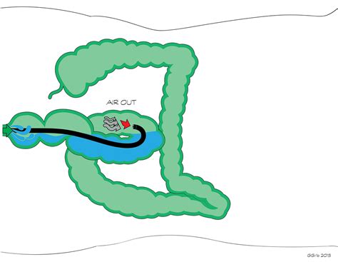 Image result for Colonoscopy Sigma Loop