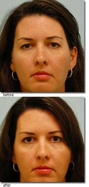 Image result for Botox Tutorial