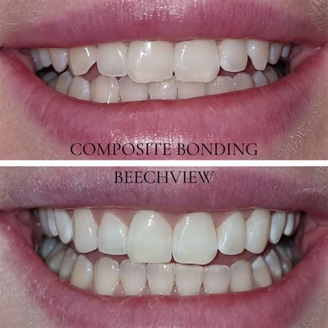 Composite Bonding in Blanchardstown | Beechview Dental