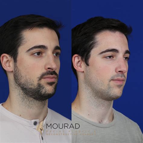 Saddle Nose Deformity Celebrity