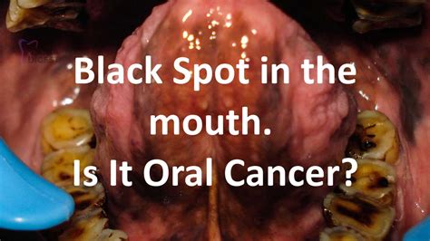 Black Spot On Gums. Is It Oral Cancer? | Dentadigest