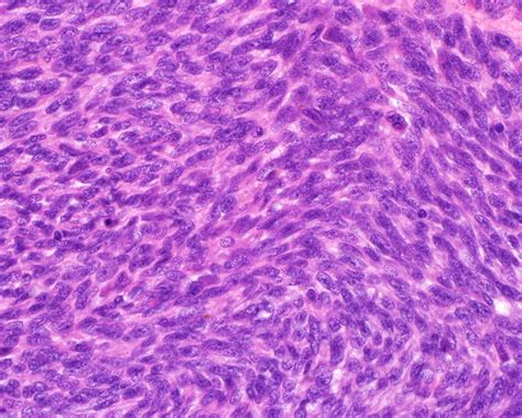 Spindle Cell Sarcomas - Surgical Pathology Clinics