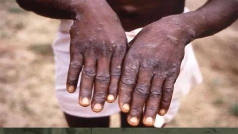 Monkeypox: एक घंटे में पता चलेगा आप मंकीपाक्स संक्रमित हैं या नहीं ...