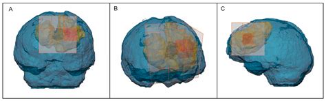 Predicting Regions of Local Recurrence in Glioblastomas Using Voxel ...