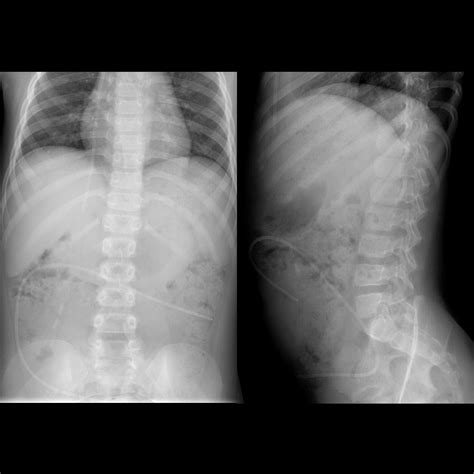 Signs Of Shunt Malfunction