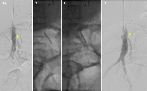 Inferior Mesenteric Artery Revascularization Can Supplement Salvage of Mesenteric Ischemia ...