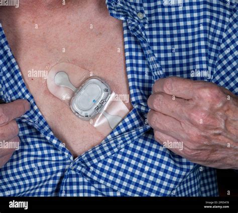 Chest Heart Rate Monitor Ecg at Martin Horvath blog