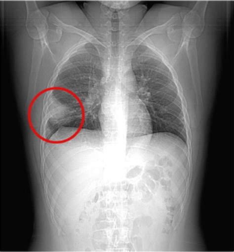Chest X Ray Pulmonary Embolism at Makayla Hampton blog