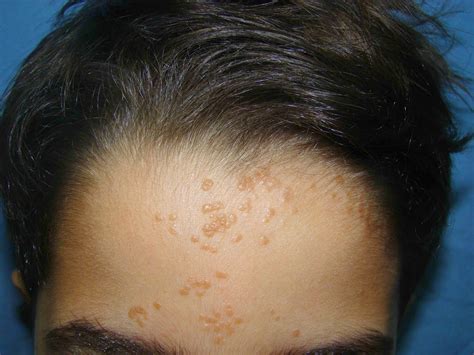 Photos of Warts on Face ~ How To Remove Moles, Warts, Skin Tags Safely