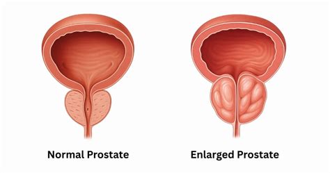 Image result for Normal Prostate Levels