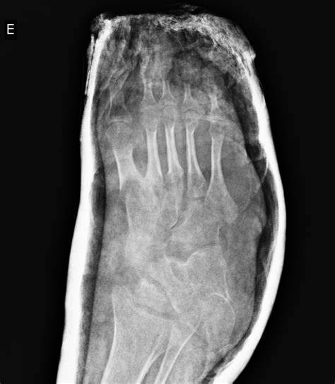 Talipes Equinovarus Classification at Alice Fisher blog
