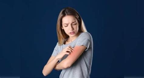 This skin rash could be a symptom of Covid-19 and here's what the ...