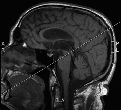 CSF Flow SCSN MRI 的图像结果