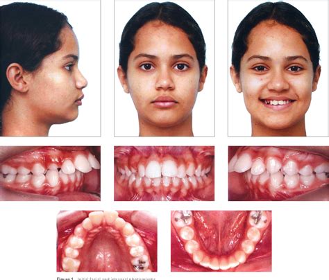 Class Ii Malocclusion