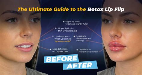 Lip Flip 101: Everything You Need to Know | Estherian Clinic