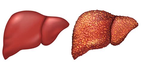 Liver Cirrhosis Treatment | Dr. Kiran Peddi