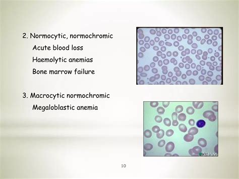 Anemia Causes, Types, Symptoms, Diet, and Treatment | PPTX