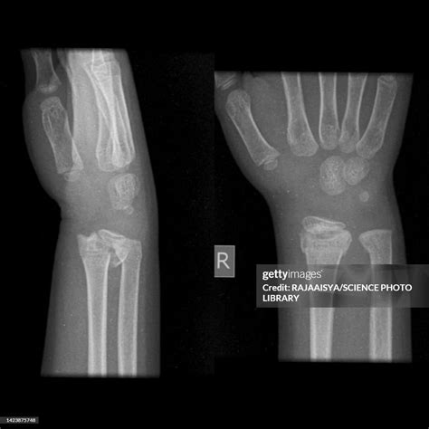 Growth Plate Fracture Xray High-Res Stock Photo - Getty Images
