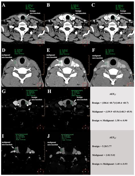 Predictive Value of Arterial Enhancement Fraction Derived from Dual ...