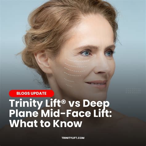 Minimally Invasive Facelift - Trinity Lift