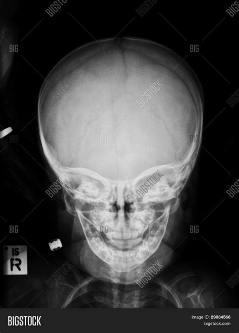 Childs Skull X-ray Image & Photo (Free Trial) | Bigstock