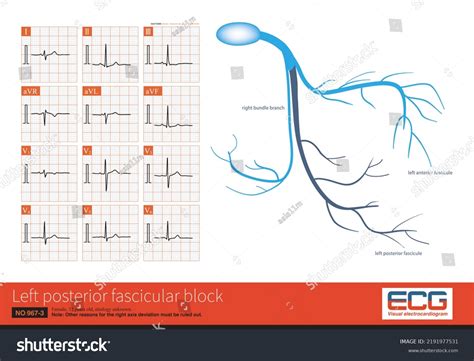 During Left Posterior Fascicular Block Ecg: ภาพประกอบสต็อก 2191977531 ...