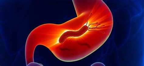 Artículos sobre helicobacter pylori | Live-Med
