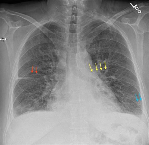 yellow arrows = Kerley A blue arrows = Kerley B red arrows = Kerley C