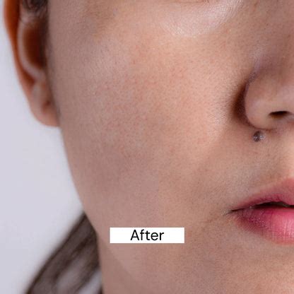 Buy Best Pigmentation Cream Online | Dark Spot Removal | 25% Off